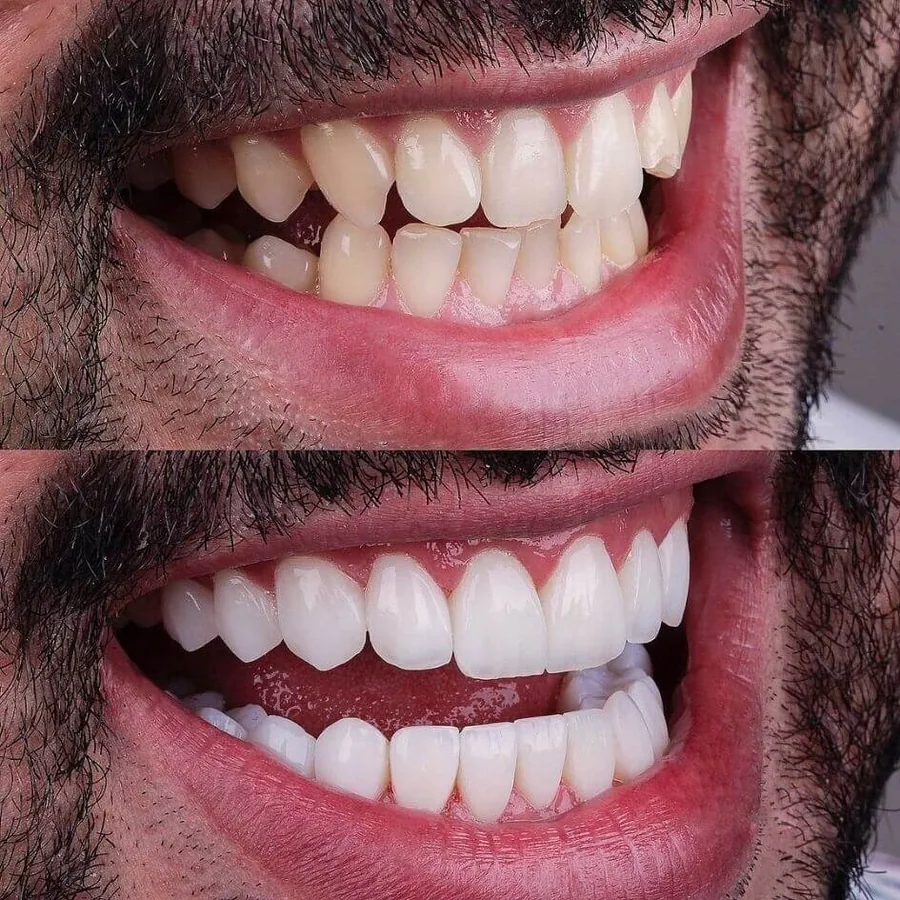 Complete smile design makeover before and after, Just Smile Miami patient