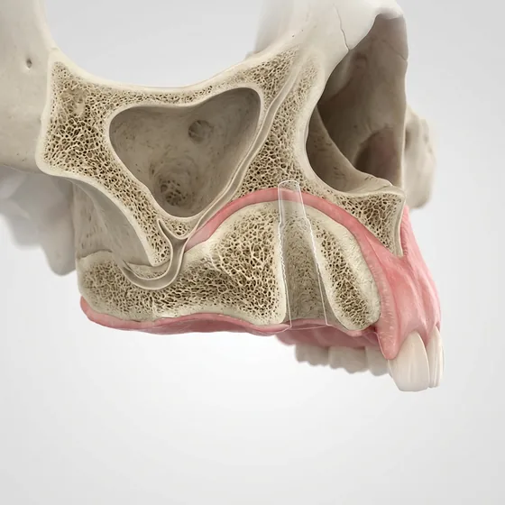 Rebuilt thick healthy bone ready for an implant