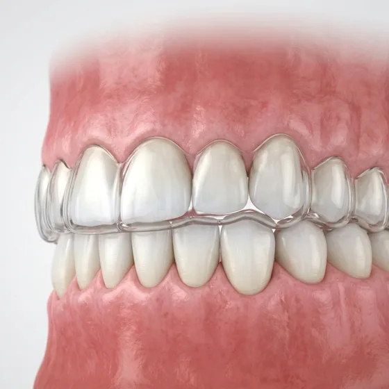 Teeth protected by a clear custom night guard