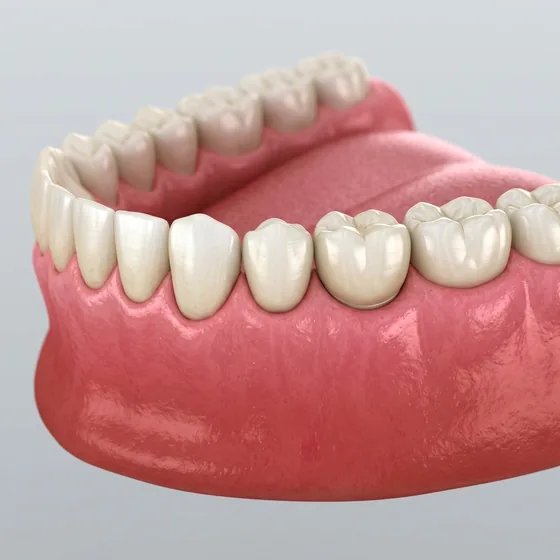 The gap filled with a natural implant crown