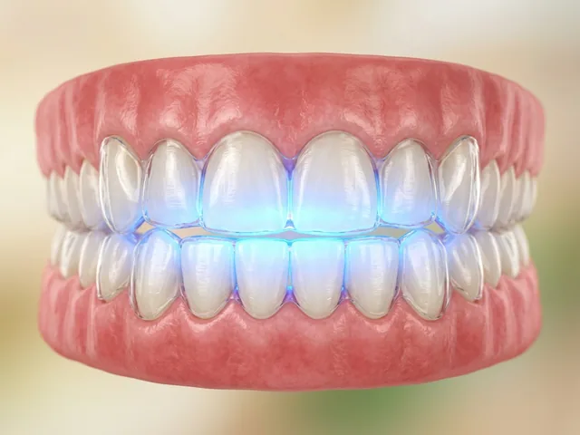 Una luz azul de blanqueamiento activando el gel
