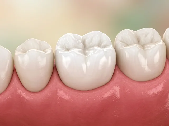 El mismo molar restaurado por completo con una corona blanca natural