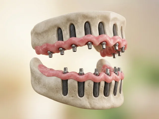Implantes dentales colocados como base en la mandíbula
